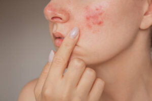 Future of Acne Control: Laser Treatment Advancements