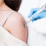 Can-Laser-Tattoo-Removal-Treat-Multiple-Body-Areas-at-Onc.jpg