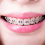 Dental-Braces-Cost-in-Riyadh-16.jpg